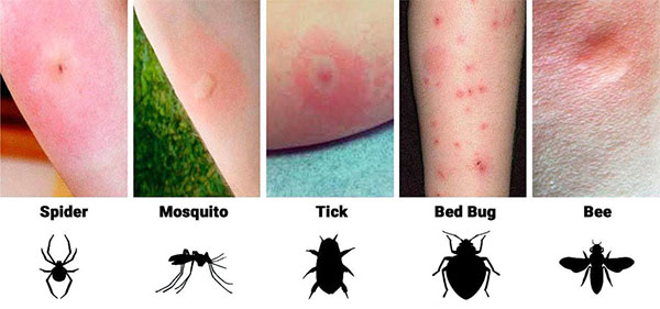 Mosquito Bite Bed Bug Bite Difference